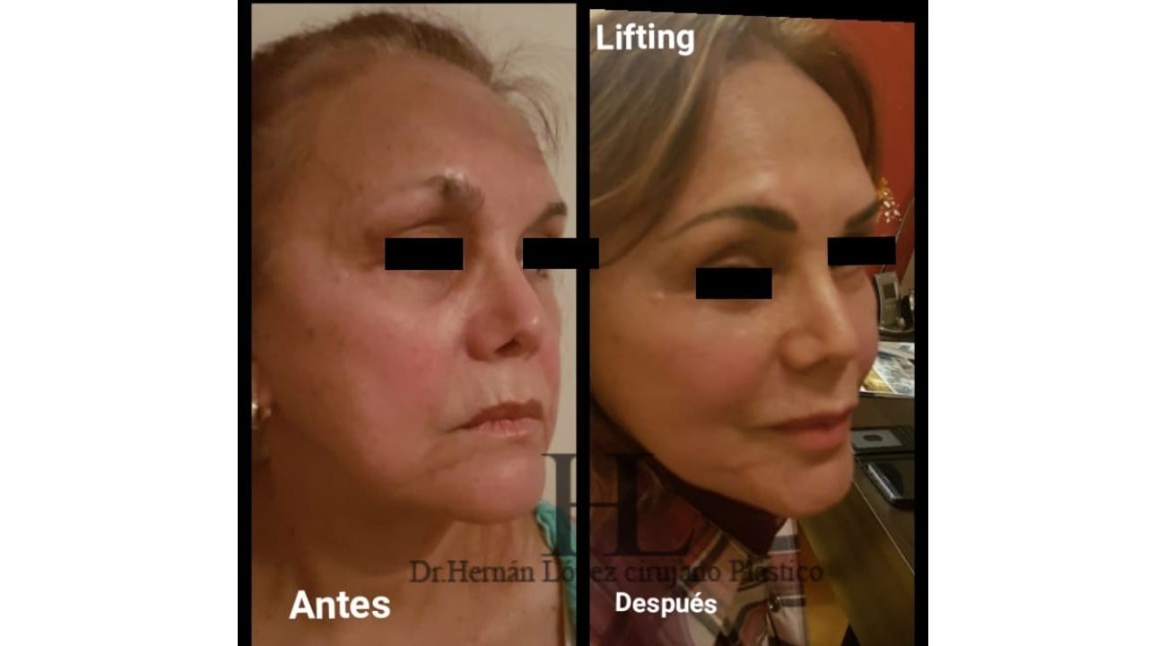 Lifting facial