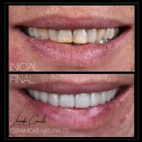 Cosmética Dental Digitalmente Guiada