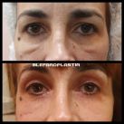 La blefaroplastia