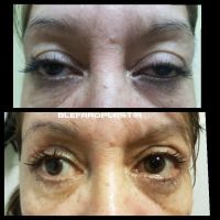 La blefaroplastia