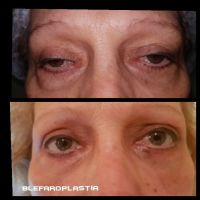 La blefaroplastia