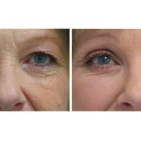 Blefaroplastia: Rejuvenecer la mirada, de la mano de Especialistas