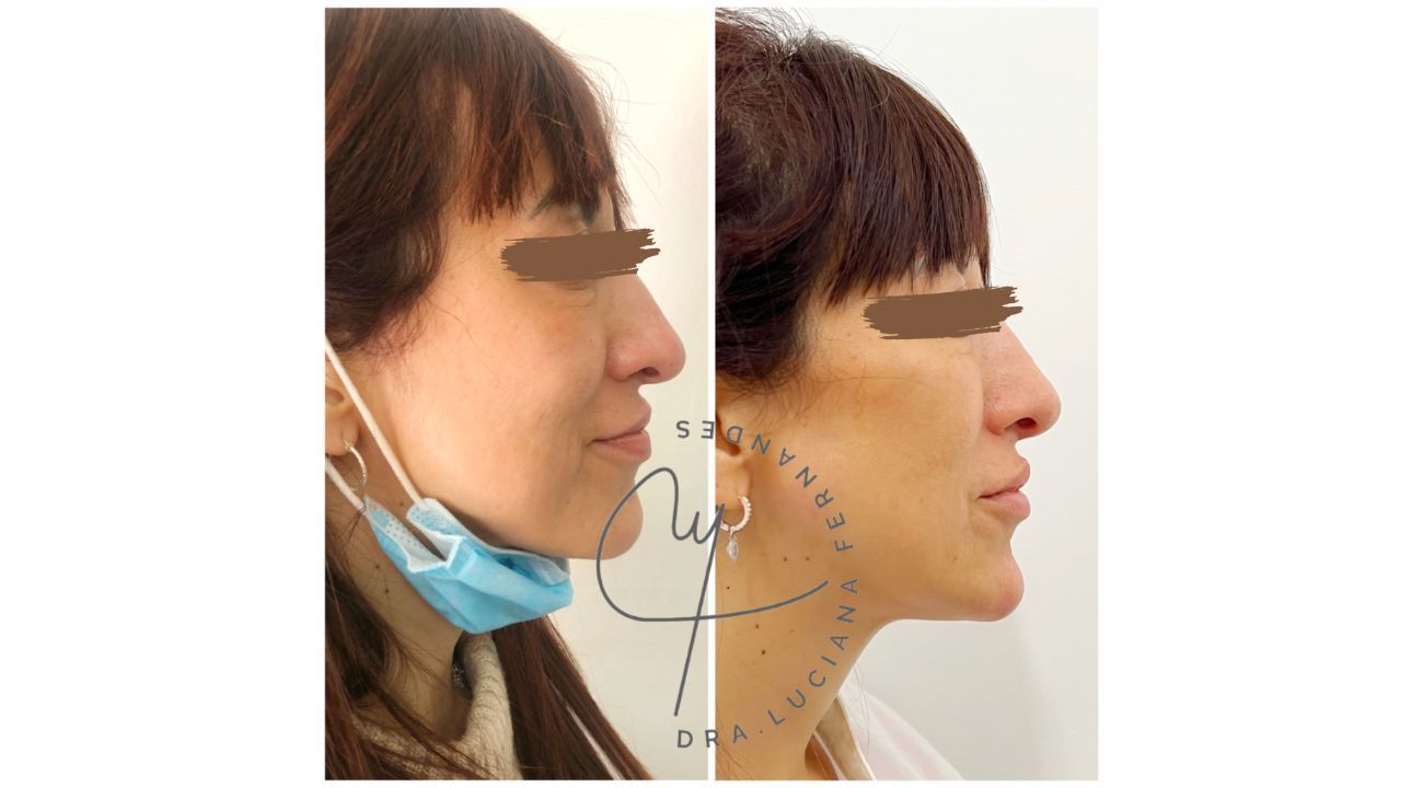 Dra Luciana Fernandes: Lifting líquido, la evolución de la medicina estética 