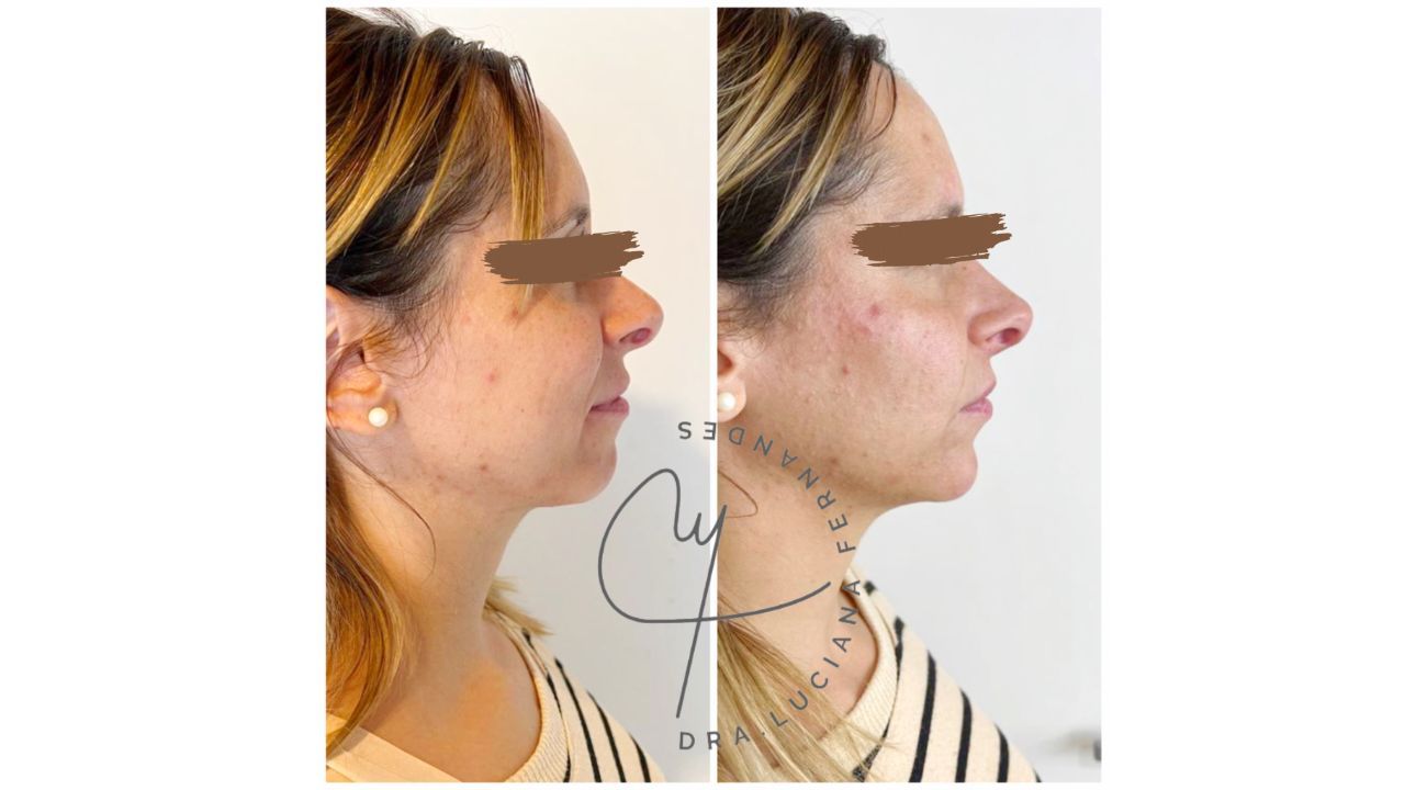 Dra Luciana Fernandes: Lifting líquido, la evolución de la medicina estética 