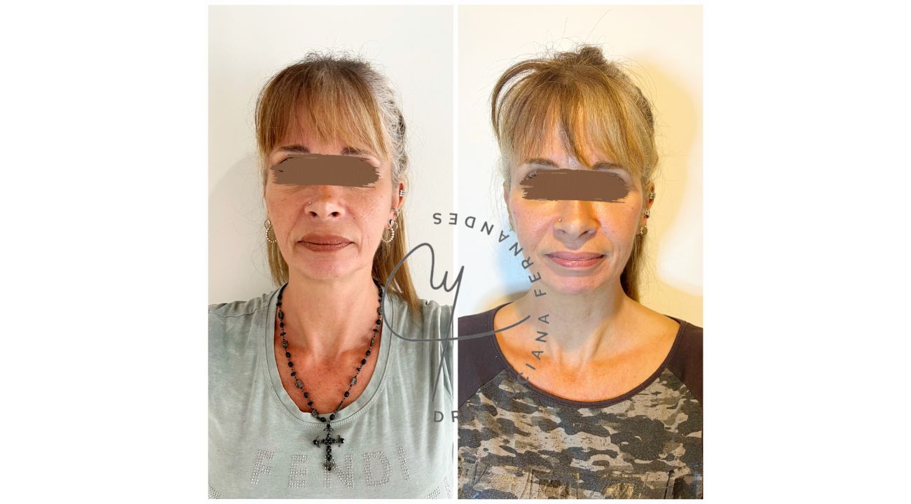 Dra Luciana Fernandes: Lifting líquido, la evolución de la medicina estética 