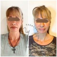 Dra Luciana Fernandes: Lifting líquido, la evolución de la medicina estética 