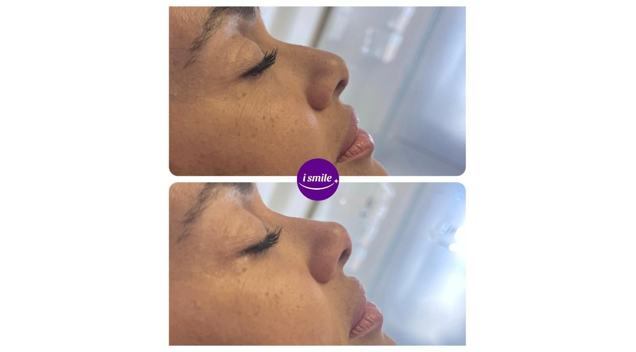 Los verdaderos beneficios de la Armonización Facial: Dra Ines Añó