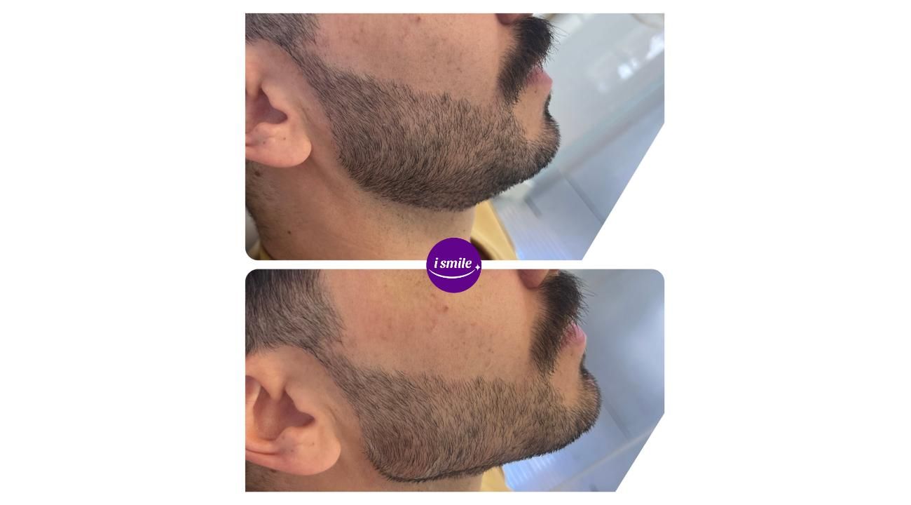 Los verdaderos beneficios de la Armonización Facial: Dra Ines Añó