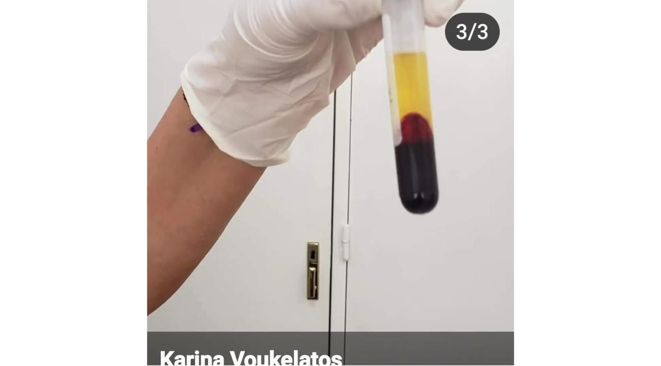 BENEFICIOS DEL PLASMA RICO EN PLAQUETAS 