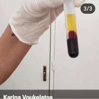 BENEFICIOS DEL PLASMA RICO EN PLAQUETAS 