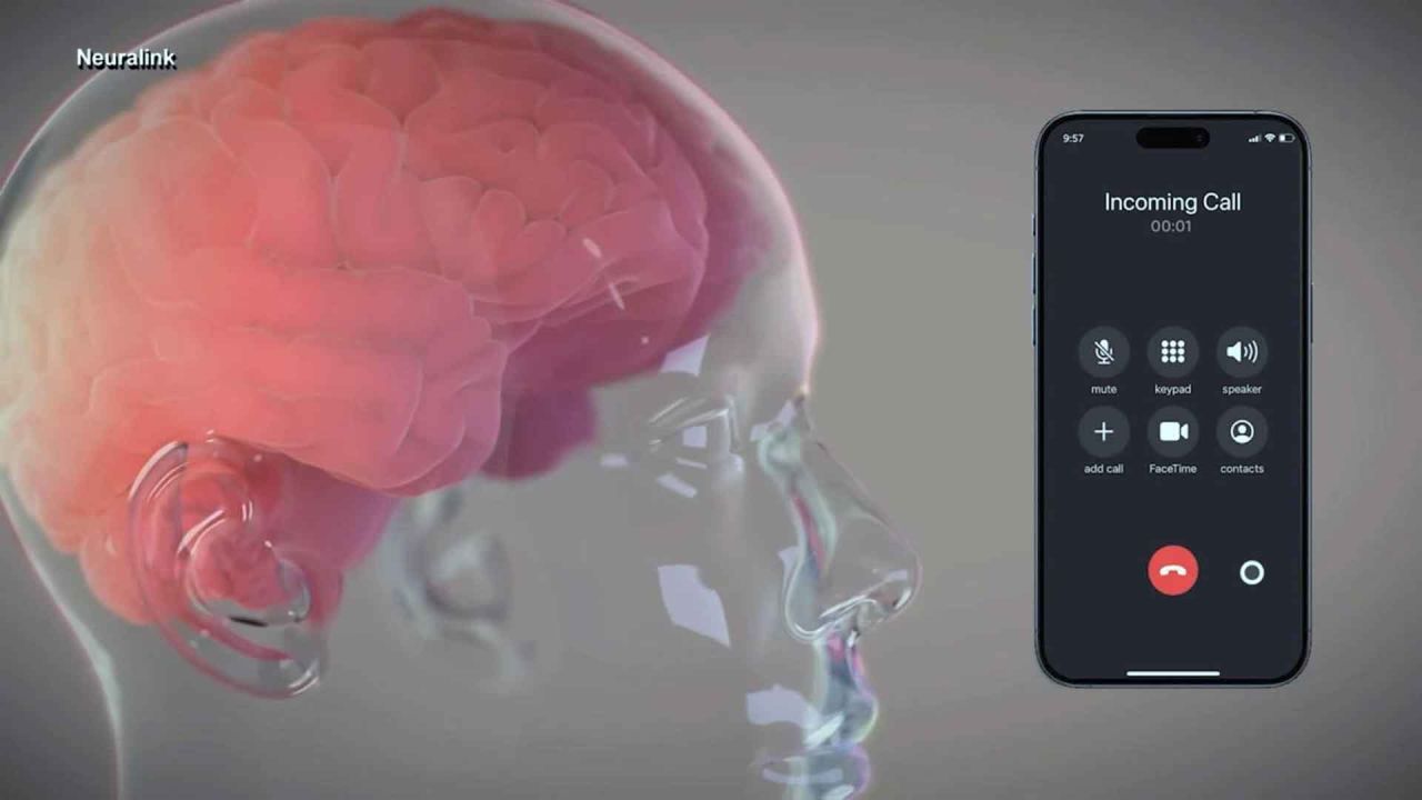 El chip cerebral permitiría comunicarse con dispositivos varios. | Foto:Gentileza Neuralink.