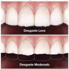 Conocé de la mano de la Dra. Karina Pugliese de Araoz Dental los mejores Tips para Proteger tus Dientes del Desgaste Dental