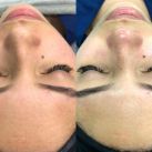 Limpieza Facial Profunda: Descubre el Secreto para una Piel Radiante