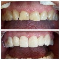 Conocé de la mano de la Dra. Karina Pugliese de Araoz Dental los mejores Tips para Proteger tus Dientes del Desgaste Dental