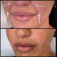 “Lifting Líquido” para el Tratamiento del Surco Nasogeniano: ¿Prevención o Corrección? Por la Dra. Ivana Motiejunas