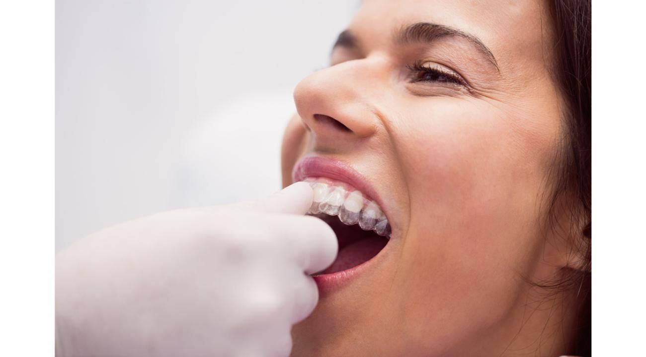 Alinear los dientes sin brackets: ¡El nuevo boom! 