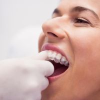 Alinear los dientes sin brackets: ¡El nuevo boom!