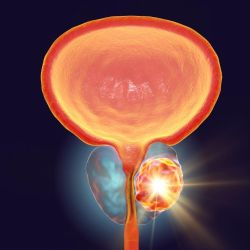 Cómo Detectar y Tratar el Cáncer de Próstata Efectivamente, por el Dr Mauro Carrillo | Foto:CEDOC