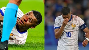 Mbappe Golpe nariz