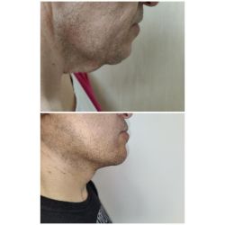 Rejuvenecé tu rostro: La solución del lifting para una apariencia fresca y natural | Foto:CEDOC