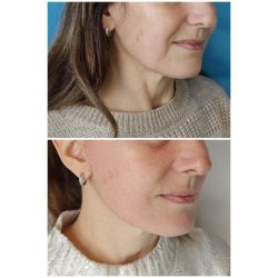 Rejuvenecé tu rostro: La solución del lifting para una apariencia fresca y natural | Foto:CEDOC