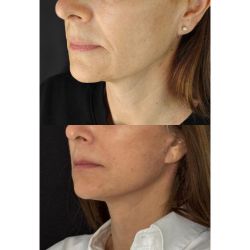 Rejuvenecé tu rostro: La solución del lifting para una apariencia fresca y natural | Foto:CEDOC