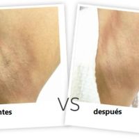 SkinCare vs. depilación láser