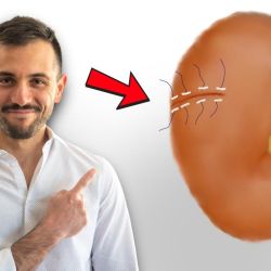 Tratamiento Quirúrgico del Cáncer Renal localizado: En qué consiste una Cirugía laparoscópica de Riñón por el Urólogo Mauro Carrillo | Foto:CEDOC