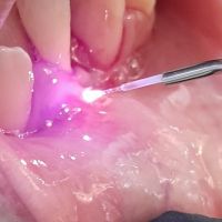 Odontología Avanzada: El Impacto del Láser en la Práctica Dental con el Dr. Gastón Pocai y la Dra. Vanesa García