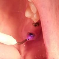 Odontología Avanzada: El Impacto del Láser en la Práctica Dental con el Dr. Gastón Pocai y la Dra. Vanesa García