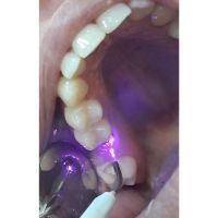 Odontología Avanzada: El Impacto del Láser en la Práctica Dental con el Dr. Gastón Pocai y la Dra. Vanesa García