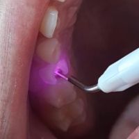 Odontología Avanzada: El Impacto del Láser en la Práctica Dental con el Dr. Gastón Pocai y la Dra. Vanesa García