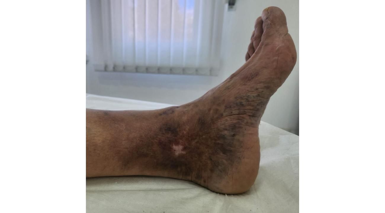 Cómo eliminar tus várices sin cirugía: Esclerosis guiada por ecografía en ROMA Medicina Estética