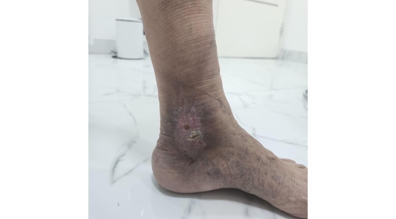 Cómo eliminar tus várices sin cirugía: Esclerosis guiada por ecografía en ROMA Medicina Estética