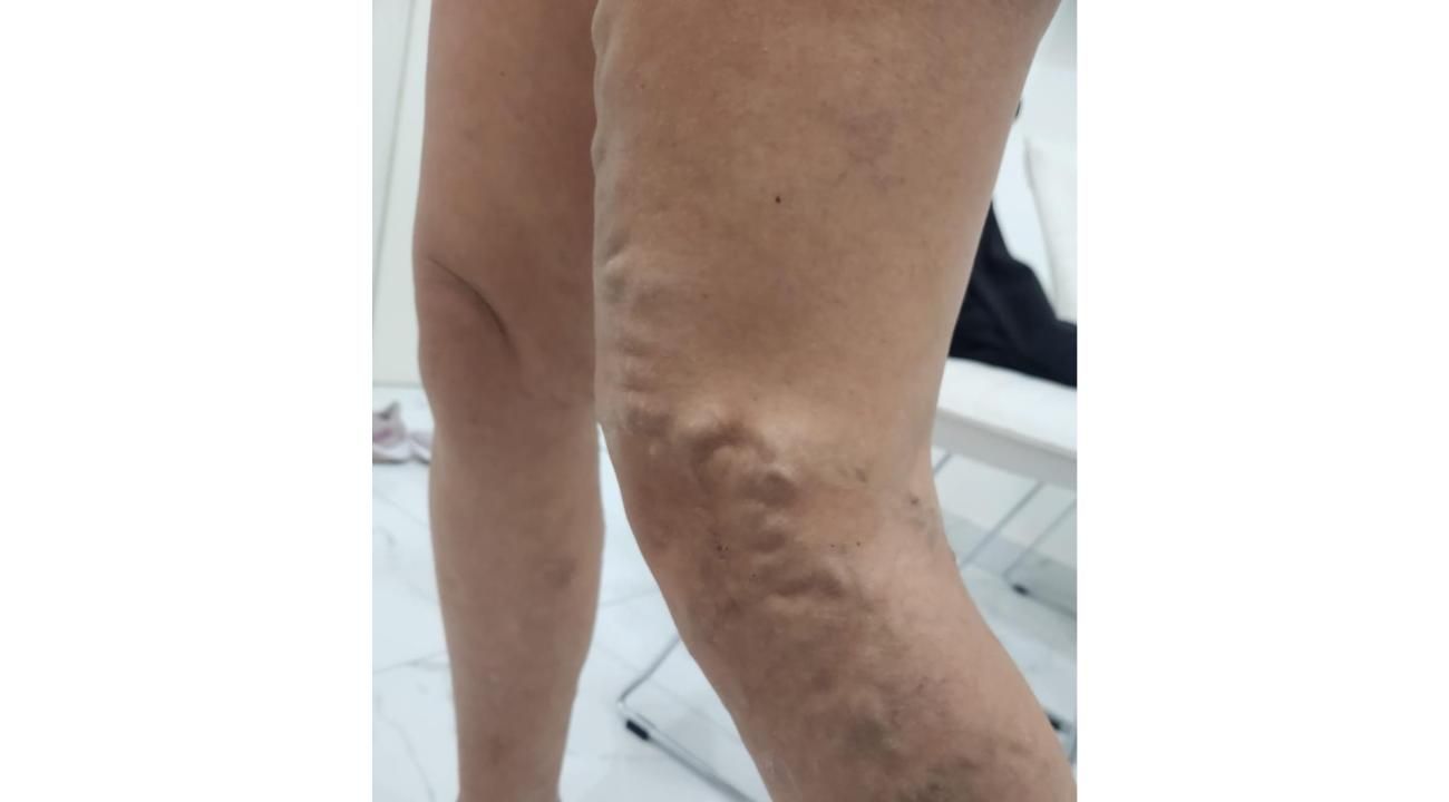 Cómo eliminar tus várices sin cirugía: Esclerosis guiada por ecografía en ROMA Medicina Estética