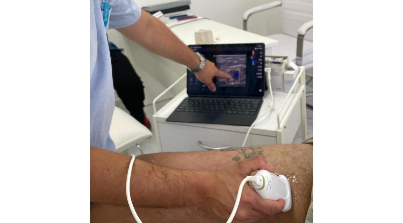 Cómo eliminar tus várices sin cirugía: Esclerosis guiada por ecografía en ROMA Medicina Estética