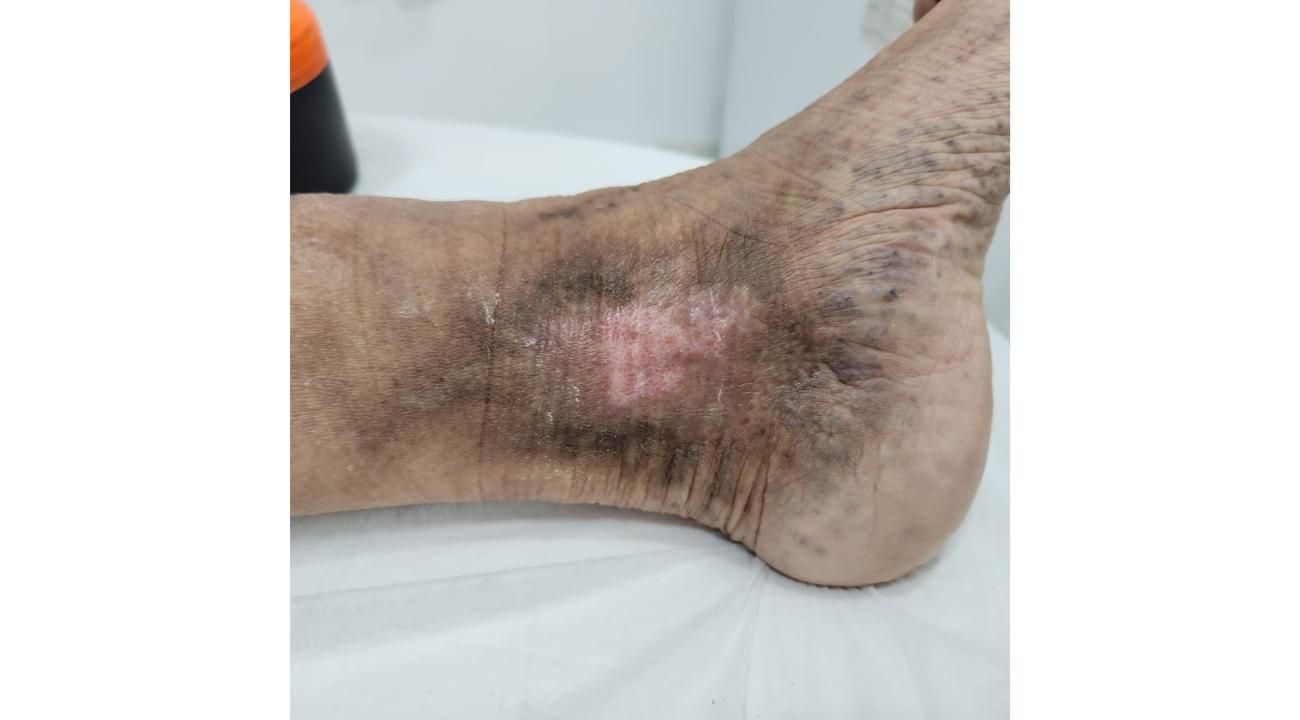 Cómo eliminar tus várices sin cirugía: Esclerosis guiada por ecografía en ROMA Medicina Estética