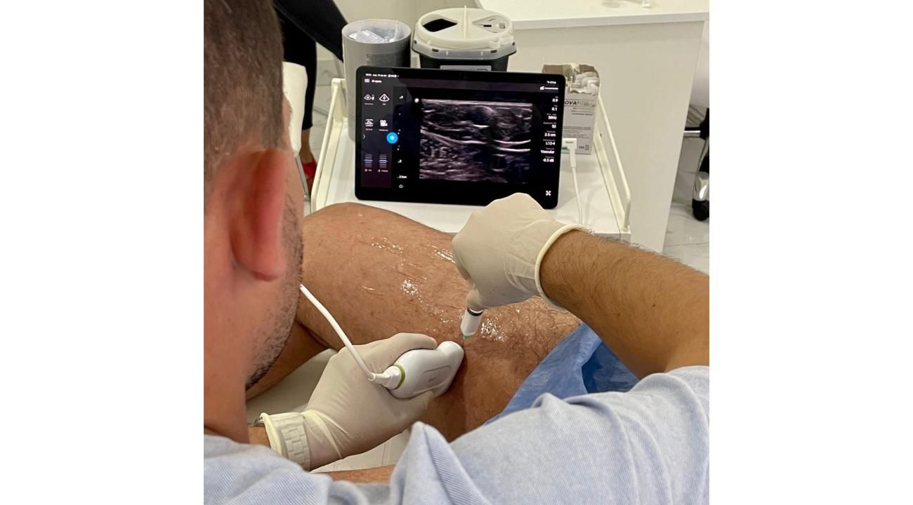 Cómo eliminar tus várices sin cirugía: Esclerosis guiada por ecografía en ROMA Medicina Estética