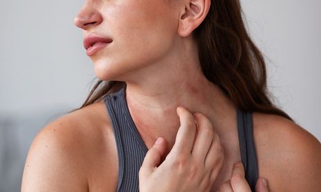Dermatitis atópica