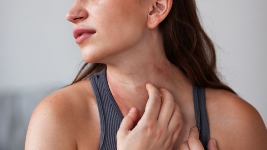 Alerta por dermatitis atópica en Argentina: advirtieron sobre demoras de hasta cinco años en el diagnóstico certero