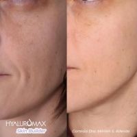 ¿Qué es Hyaluromax Skin Builder L y por qué tu piel lo necesita?