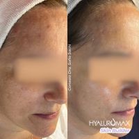 ¿Qué es Hyaluromax Skin Builder L y por qué tu piel lo necesita?