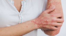 Psoriasis en la piel 20241028