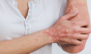 Psoriasis en la piel 20241028