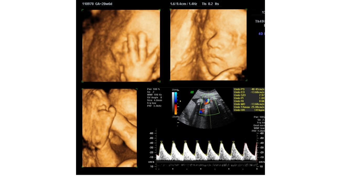 El impacto de una ecografía 5D durante el embarazo 