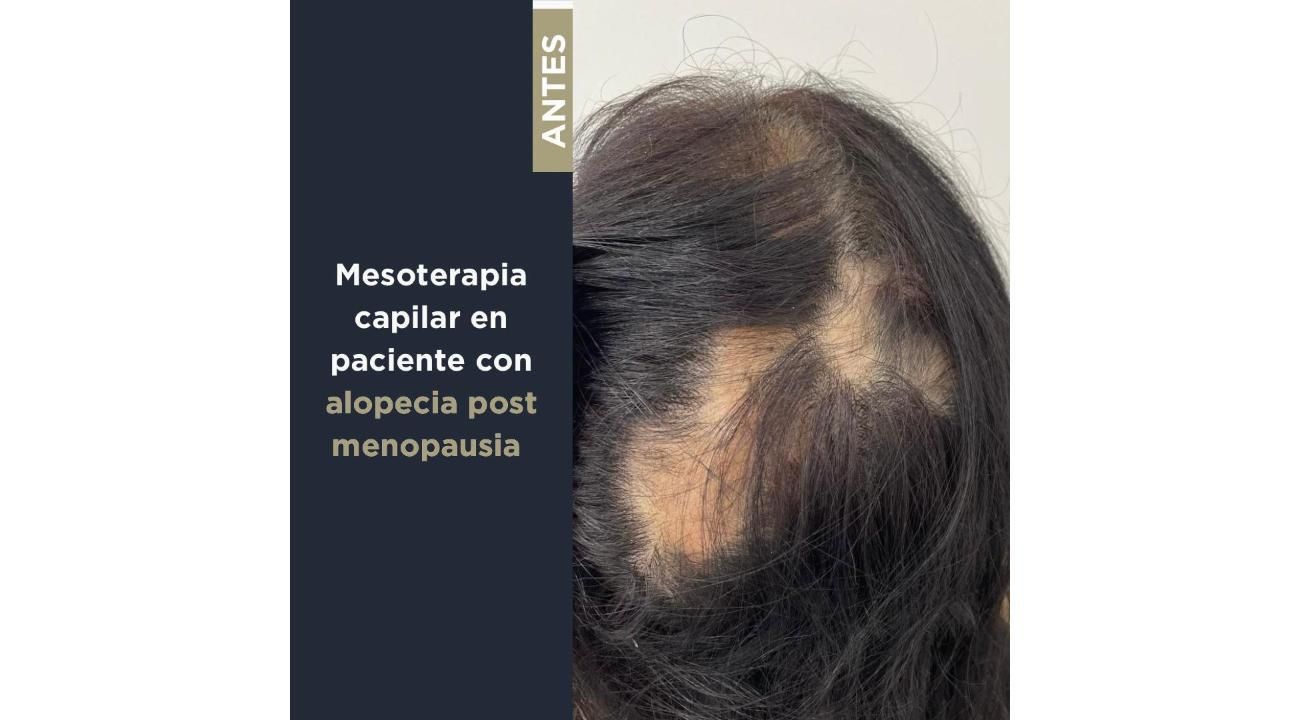 Revitaliza tu Cabello: Mesoterapia Capilar y Plasma Rico en Plaquetas en ROMA Medicina Estética (Mar del Plata) 