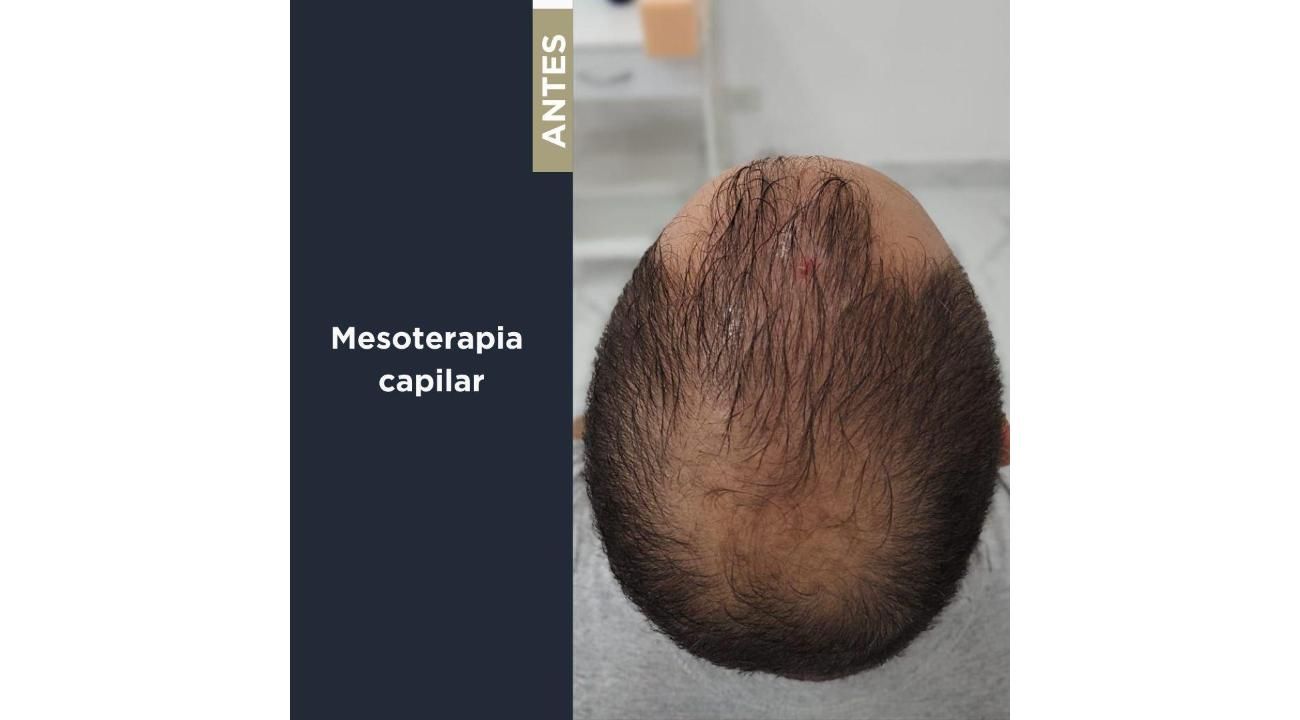 Revitaliza tu Cabello: Mesoterapia Capilar y Plasma Rico en Plaquetas en ROMA Medicina Estética (Mar del Plata) 