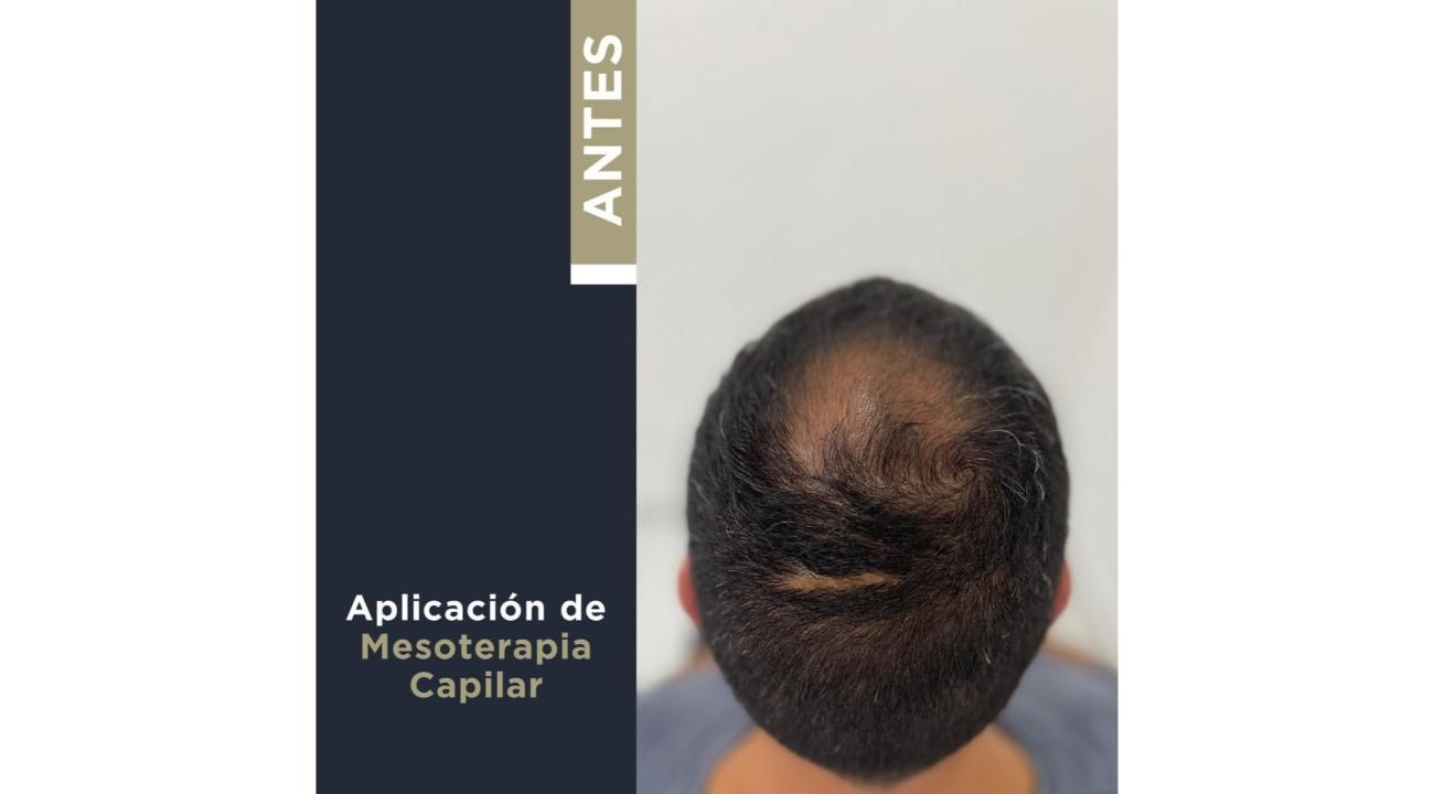 Revitaliza tu Cabello: Mesoterapia Capilar y Plasma Rico en Plaquetas en ROMA Medicina Estética (Mar del Plata) 