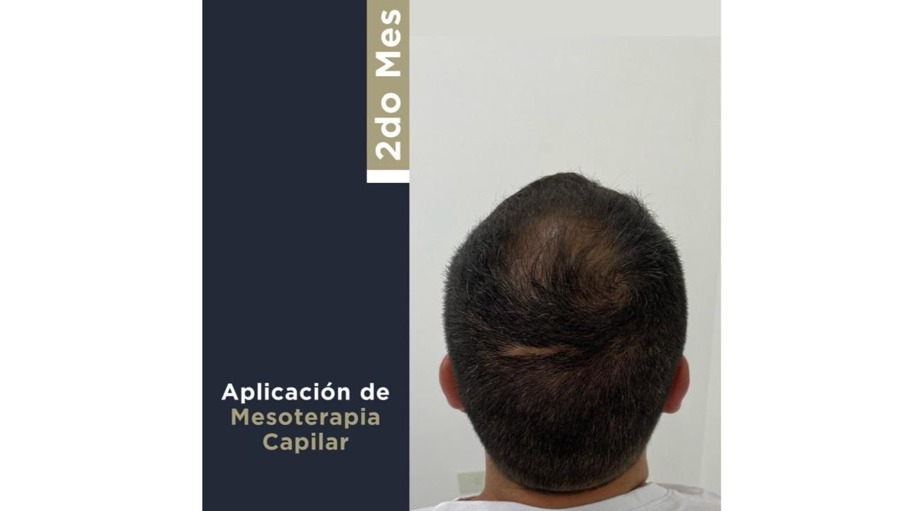 Revitaliza tu Cabello: Mesoterapia Capilar y Plasma Rico en Plaquetas en ROMA Medicina Estética (Mar del Plata) 