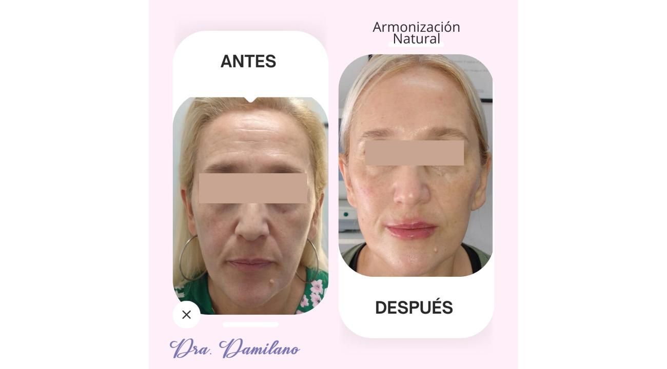 Dra. Gabriela Damilano: Cómo evitar el síndrome de Overfilled Facial y lograr un rejuvenecimiento natural